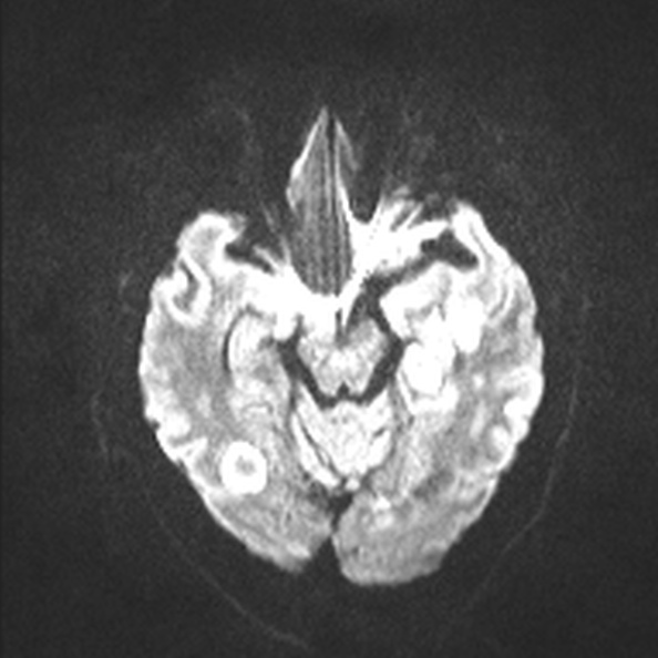 Acute disseminated encephalomyelitis (Radiopaedia 37253-39033 Axial DWI 38).jpg