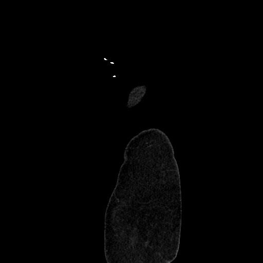 Acute diverticulitis - transverse colon (Radiopaedia 87063-103327 Sagittal C+ portal venous phase 233).jpg