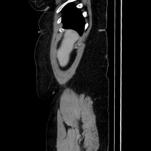 Acute diverticulitis - transverse colon (Radiopaedia 87063-103327 Sagittal C+ portal venous phase 51).jpg