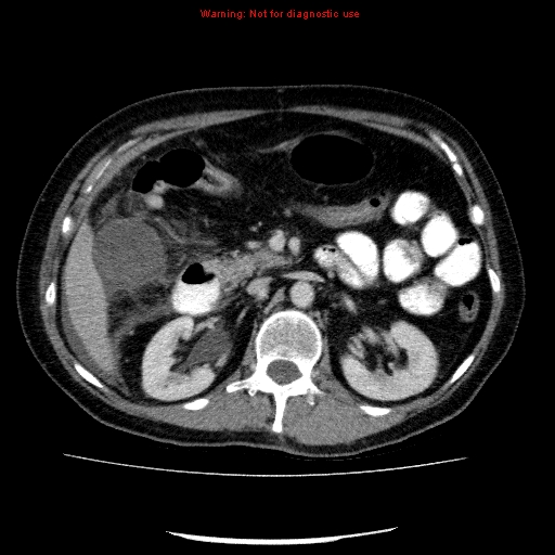 Acute gangrenous cholecystitis (Radiopaedia 10123-10661 Axial C+ portal venous phase 38).jpg
