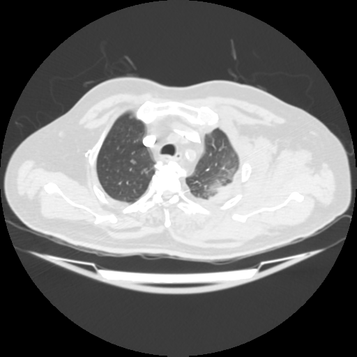 File:Acute heart failure (CT) (Radiopaedia 79835-93075 Axial lung window 9).png