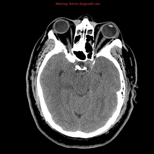 Acute hemorrhagic leukoencephalitis (Radiopaedia 14076-13920 Axial non-contrast 17).jpg