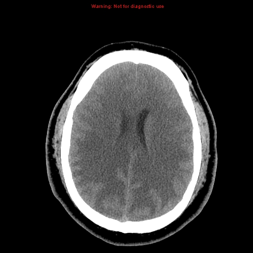Acute hemorrhagic leukoencephalitis (Radiopaedia 14076-13920 Axial non-contrast 32).jpg