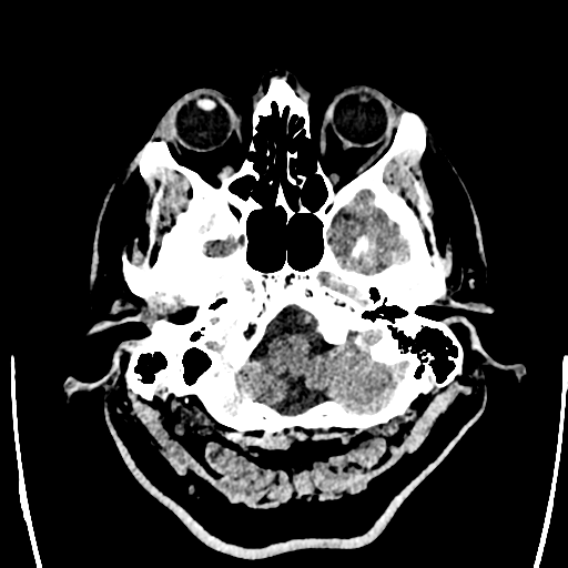 File:Acute left middle cerebral artery territory ischemic stroke (Radiopaedia 35688-37223 Axial non-contrast 8).png