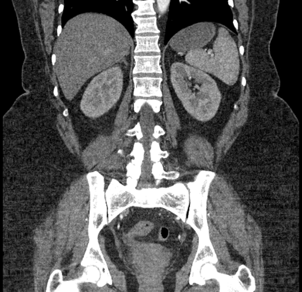 Acute mesenteric ischemia (Radiopaedia 80029-93316 Coronal C+ arterial phase 99).jpg