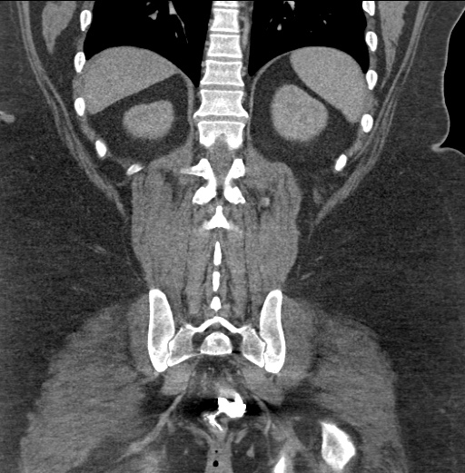 Acute mesenteric venous ischemia (Radiopaedia 46041-50383 Coronal C+ portal venous phase 75).jpg