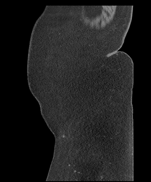 Acute mesenteric venous ischemia (Radiopaedia 46041-50383 Sagittal C+ portal venous phase 120).jpg