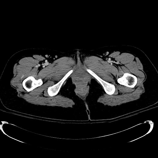 Acute myocardial infarction in CT (Radiopaedia 39947-42415 Axial C+ portal venous phase 147).jpg
