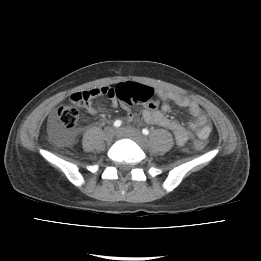File:Acute myocarditis (Radiopaedia 55988-62613 Axial C+ portal venous phase 50).jpg