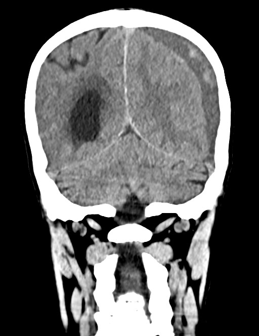Acute on chronic subdural hematoma (Radiopaedia 74814-85823 Coronal non-contrast 48).jpg