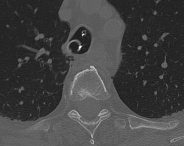 Acute on chronic subdural hematoma and thoracic vertebral injury in a multitrauma patient (Radiopaedia 31698-32619 Axial bone window 77).jpg