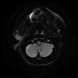 Acute otitis externa (Radiopaedia 57296-64236 Axial DWI 9).jpg