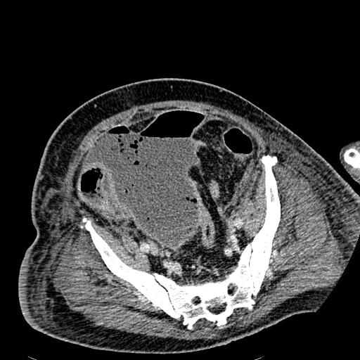 File:Acute pancreatic necrosis (Radiopaedia 13560-18501 Axial C+ portal venous phase 119).jpg