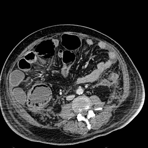 File:Acute pancreatic necrosis (Radiopaedia 13560-18501 Axial C+ portal venous phase 84).jpg