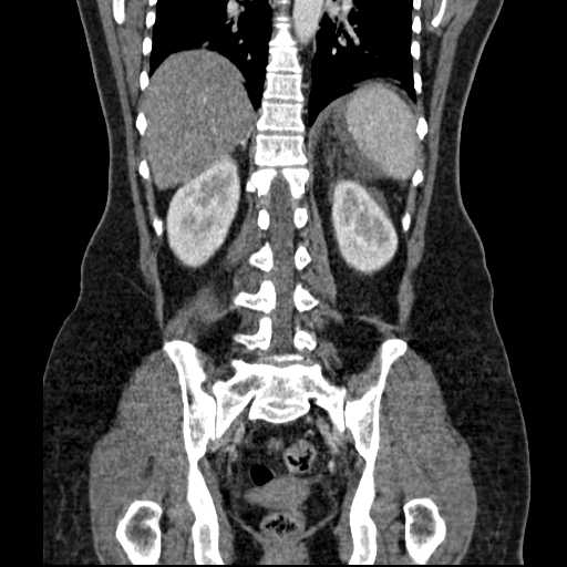 File:Acute pancreatitis (Radiopaedia 20829-20744 Coronal C+ portal venous phase 40).jpg