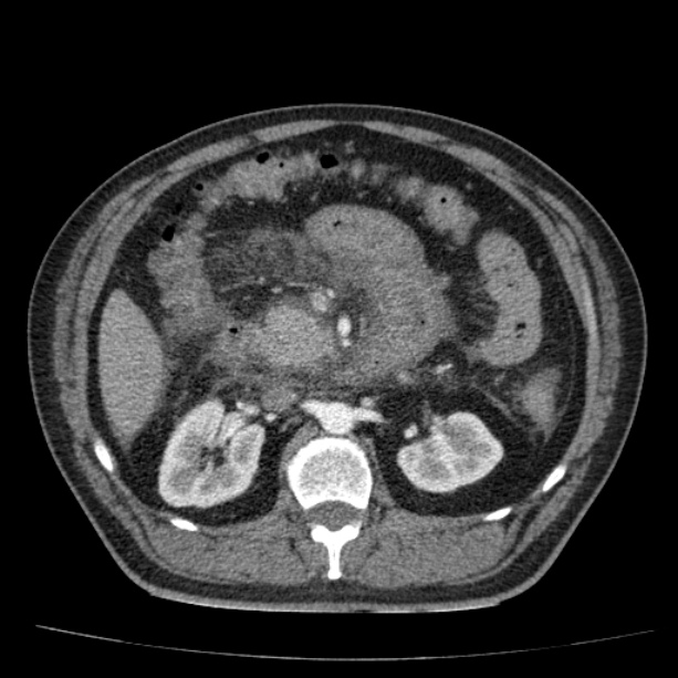 Acute pancreatitis (Radiopaedia 26663-26813 Axial C+ arterial phase 42).jpg