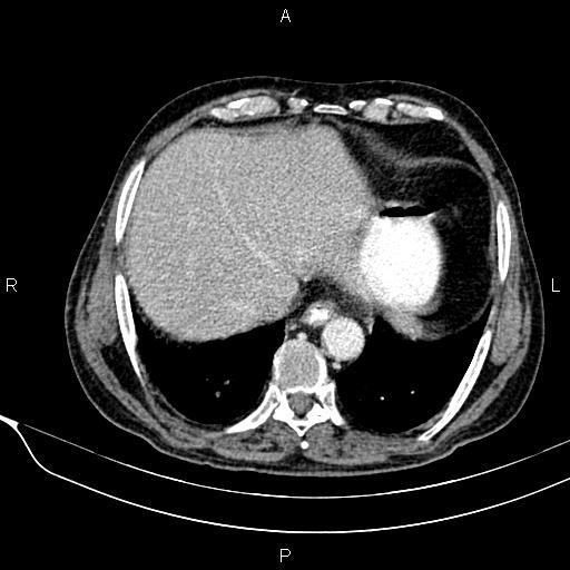 Acute pancreatitis (Radiopaedia 85146-100701 Axial C+ portal venous phase 14).jpg