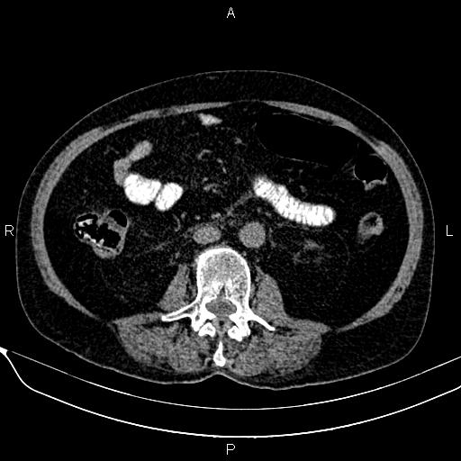 Acute pancreatitis (Radiopaedia 85146-100701 Axial non-contrast 67).jpg