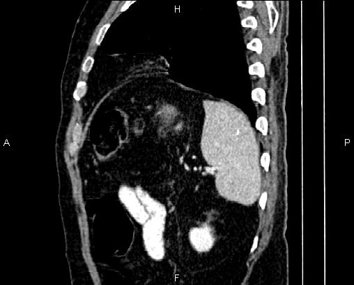 Acute pancreatitis (Radiopaedia 85146-100701 Sagittal C+ portal venous phase 79).jpg