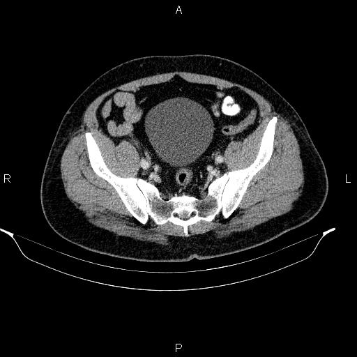 Acute pancreatitis (Radiopaedia 85390-101010 Axial C+ portal venous phase 87).jpg