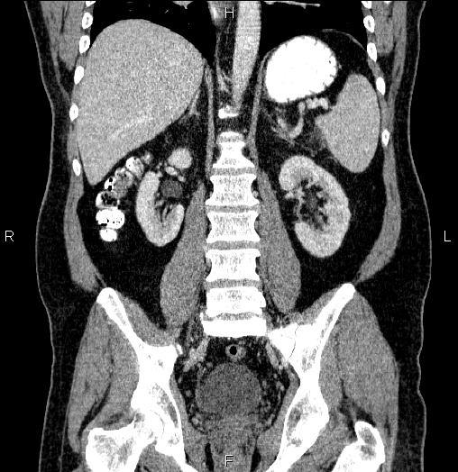 Acute pancreatitis (Radiopaedia 85390-101010 Coronal C+ portal venous phase 47).jpg