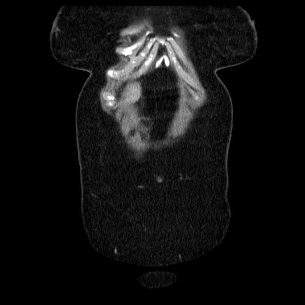 Acute pancreatitis - Balthazar C (Radiopaedia 26569-26714 Coronal C+ portal venous phase 12).jpg
