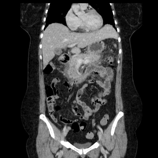 Acute pancreatitis - Balthazar C (Radiopaedia 26569-26714 Coronal C+ portal venous phase 29).jpg