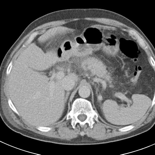 Acute pancreatitis and walled-off necrosis (Radiopaedia 29888-30403 Axial C+ delayed 23).jpg