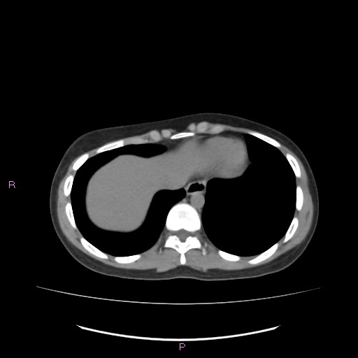 File:Acute pancreatitis secondary to stone at minor papilla and pancreatic divisum (Radiopaedia 76570-88333 Axial non-contrast 8).jpg
