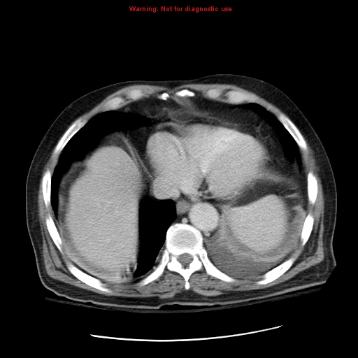 File:Acute pancreatitis with incidental pancreatic lipoma (Radiopaedia 10190-10730 Axial C+ portal venous phase 5).jpg