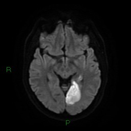 Acute posterior cerebral artery territory infarct (Radiopaedia 79329-92394 Axial DWI 13).jpg