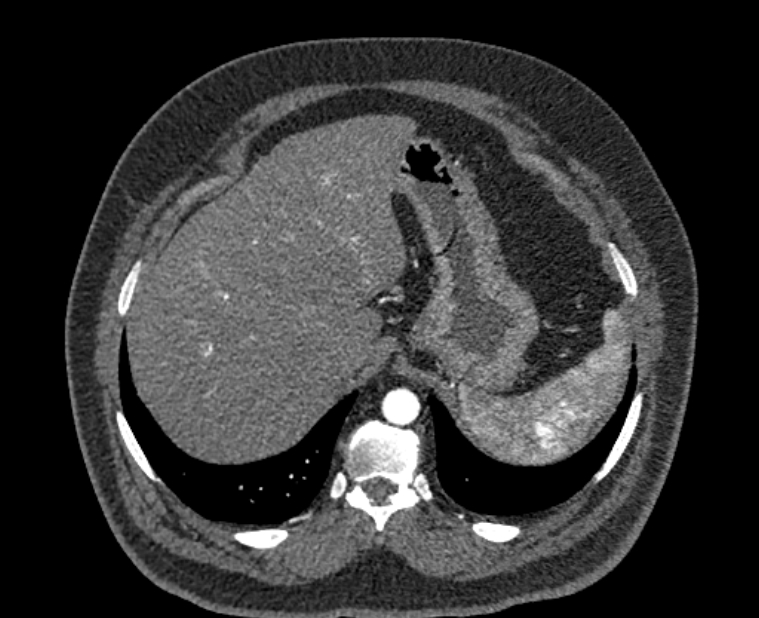 Acute pulmonary embolism with pulmonary infarcts (Radiopaedia 77688-89908 Axial C+ CTPA 64).jpg