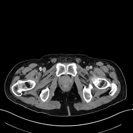 File:Acute renal infarction (Radiopaedia 59375-66736 Axial C+ portal venous phase 122).jpg