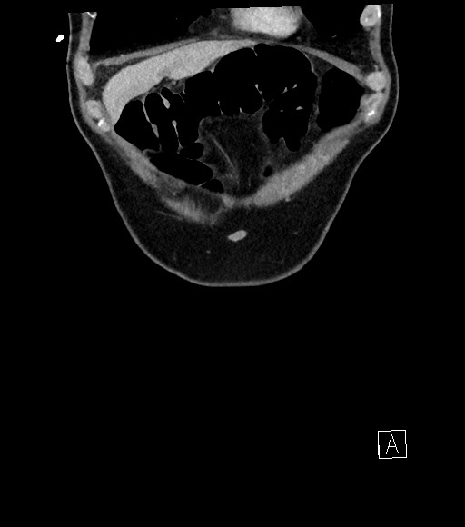 Acute renal infarction (Radiopaedia 59375-66736 Coronal C+ portal venous phase 11).jpg