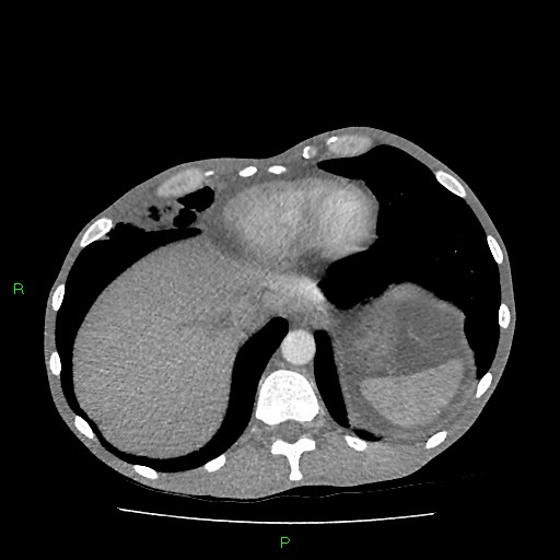File:Acute right lung abscess (Radiopaedia 34806-36258 Axial C+ arterial phase 157).jpg