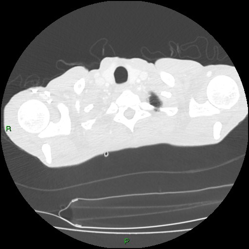 File:Acute right lung abscess (Radiopaedia 34806-36258 Axial lung window 5).jpg