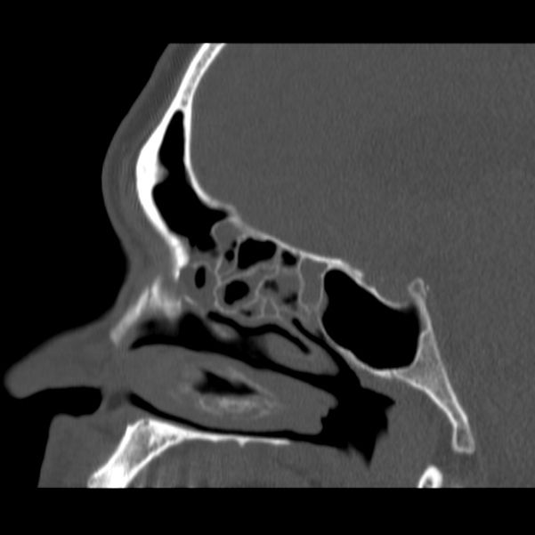 Acute sinusitis (Radiopaedia 23161-23215 Sagittal bone window 37).jpg