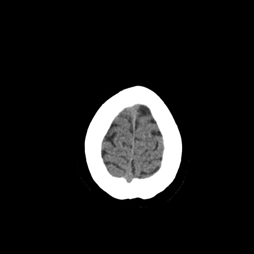 File:Acute subarachnoid hemorrhage and accessory anterior cerebral artery (Radiopaedia 69231-79008 Axial non-contrast 50).jpg
