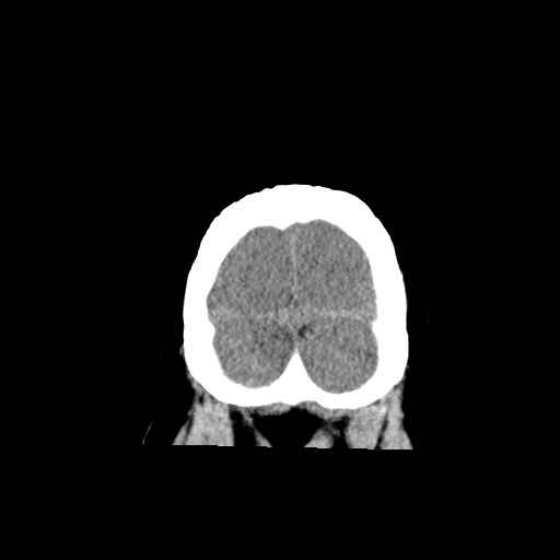 Acute subarachnoid hemorrhage and accessory anterior cerebral artery (Radiopaedia 69231-79008 Coronal non-contrast 65).jpg