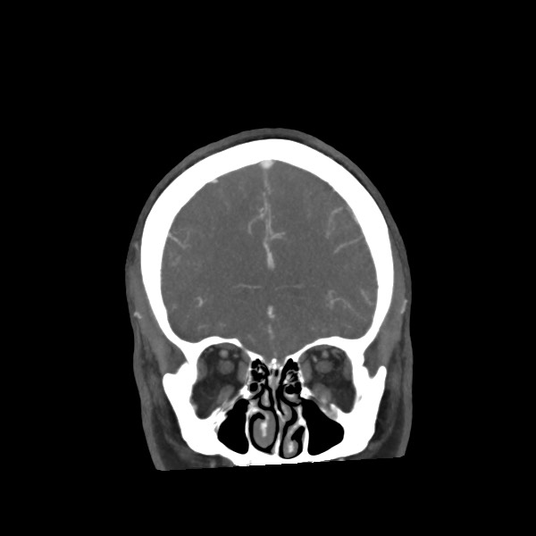 Acute subarachnoid hemorrhage and accessory anterior cerebral artery (Radiopaedia 69231-79009 Coronal C+ arterial phase 23).jpg