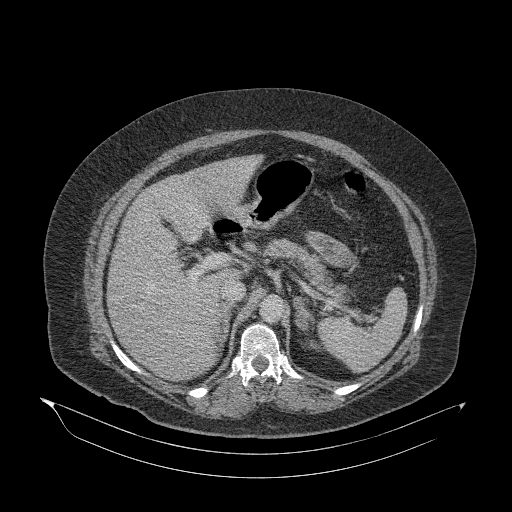 File:Acute superior mesenteric artery occlusion (Radiopaedia 51288-56960 Axial C+ portal venous phase 30).jpg