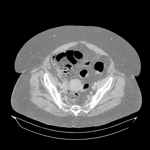Acute superior mesenteric artery occlusion (Radiopaedia 51288-56960 Axial lung window 62).jpg