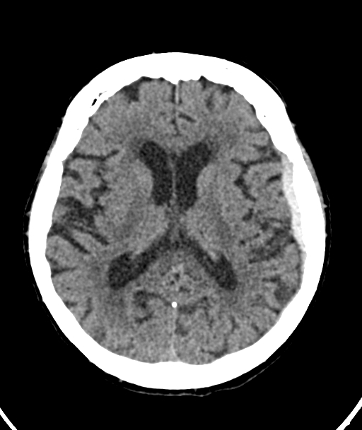 Acute traumatic subdural hematoma (Radiopaedia 82921-97257 Axial non-contrast 32).jpg