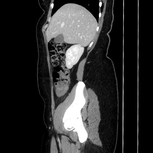 Acute uncomplicated appendicitis (Radiopaedia 73704-84499 Sagittal C+ portal venous phase 73).jpg