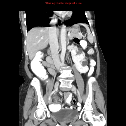File:Adenocarcinoma of the colon (Radiopaedia 8191-9039 Coronal liver window 25).jpg