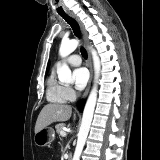 File:Adenocarcinoma of the lung (Radiopaedia 59871-67325 Sagittal C+ arterial phase 53).jpg