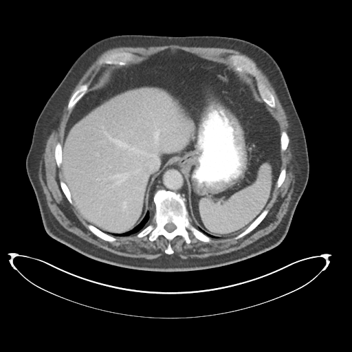 Adenocarcioma of rectum- T1 lesion (Radiopaedia 36921-38547 Axial C+ portal venous phase 17).png