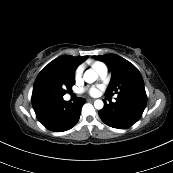 File:Adenocystic carcinoma of the trachea (Radiopaedia 47677-52525 Axial C+ arterial phase 53).jpg