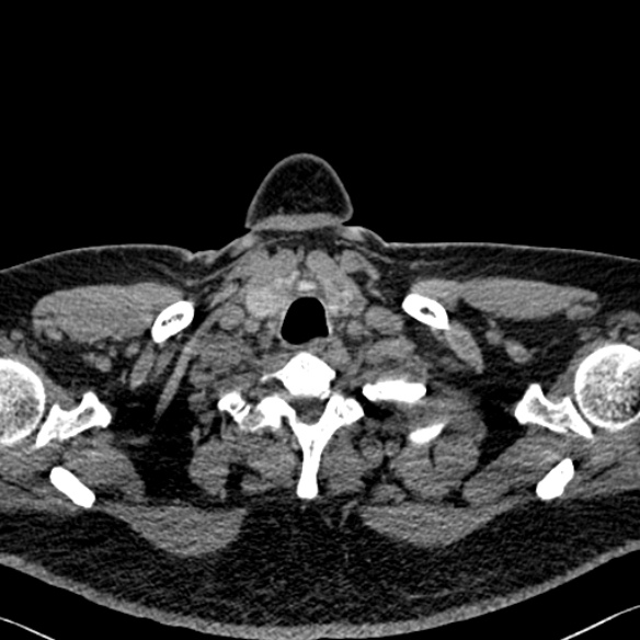 File:Adenoid cystic carcinoma of the trachea (Radiopaedia 49042-54137 Axial non-contrast 7).jpg