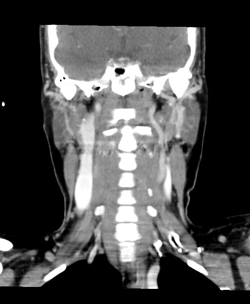 Adenoid cystic tumor of palate (Radiopaedia 46980-51518 Coronal C+ delayed 39).png